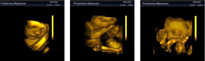 First Choice Baby Scan